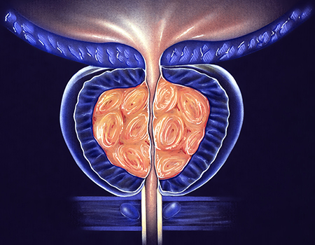 Prostatic Artery Embolization